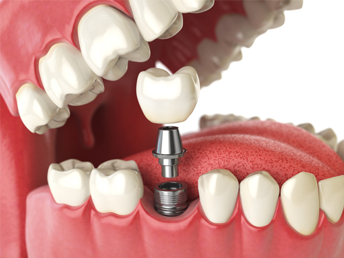 implantat dentallabor lehr